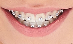 rhodium braces